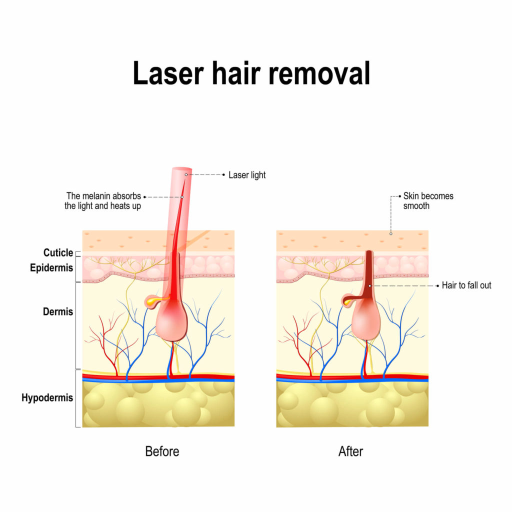 What are the Main Differences Between IPL and Laser Hair Removal |  Dermagical London