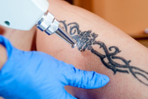 laser tattoo removal myth