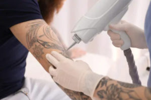 Tattoo removal on the hand with laser