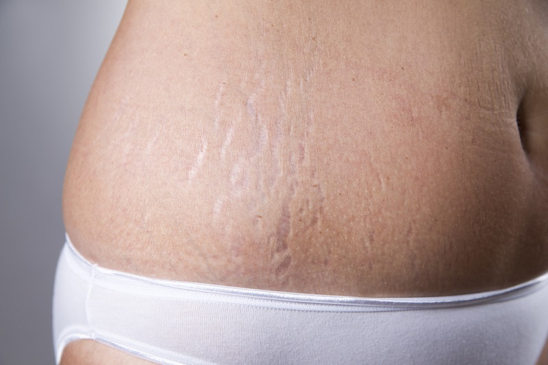 Female belly with stretch marks