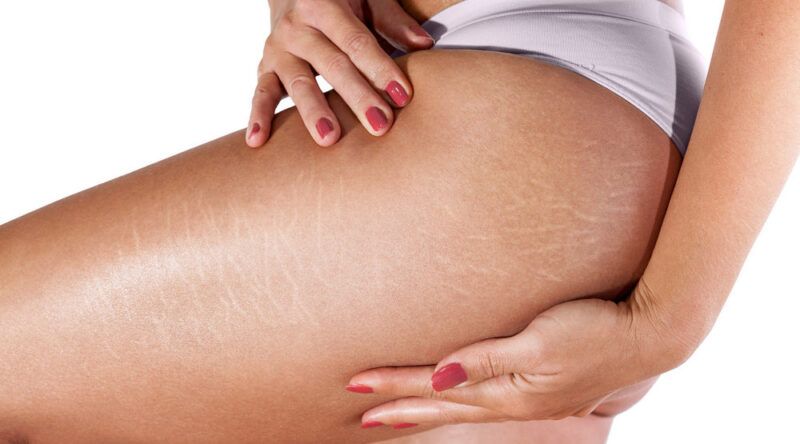 effective stretch mark removal treatment
