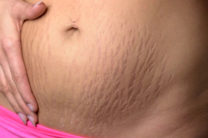 treat pregnancy stretch marks