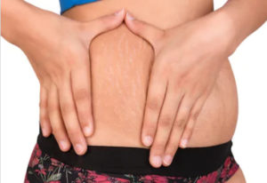 tightens the stretch marks with hands